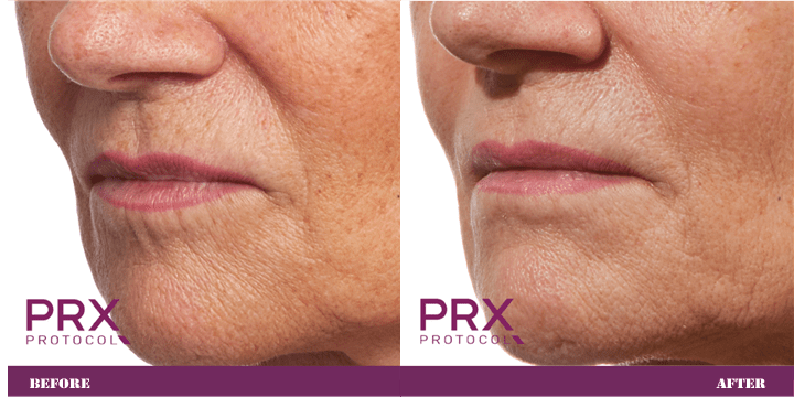 PRX-T33 treatment process and ingredients