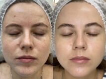 PRX-T33 facial treatment before and after results showing skin improvement