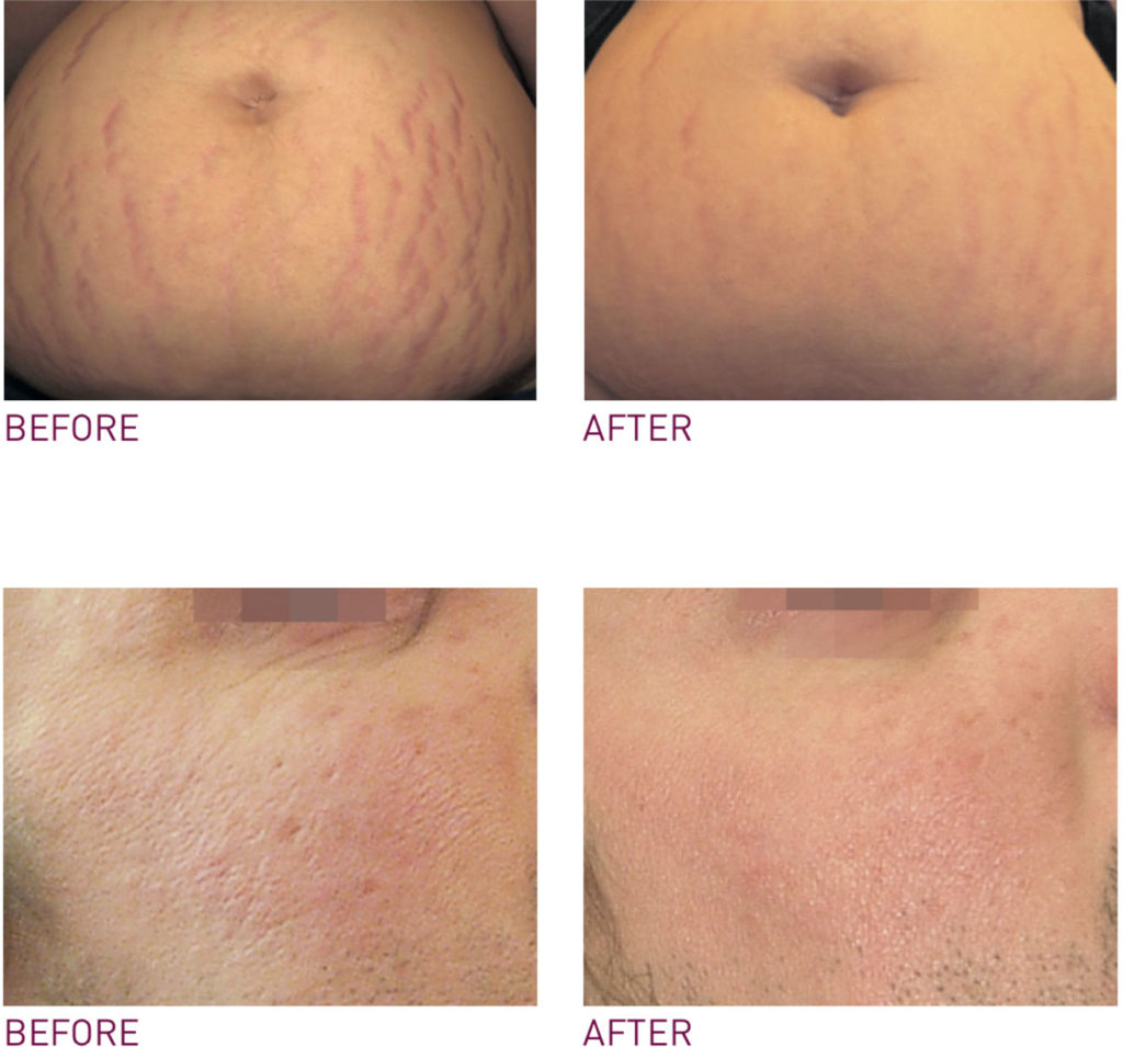 PRX-T33 body treatment before and after results showing stretch mark improvement