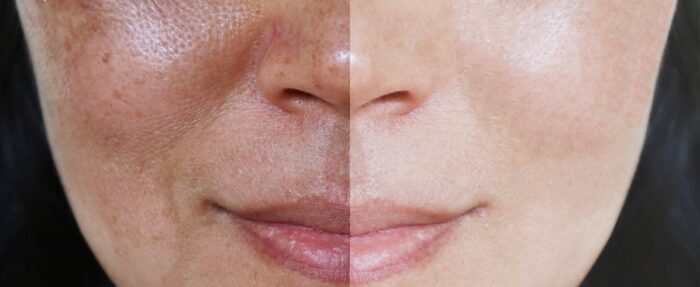 PRX-T33 treatment difference showing skin improvement