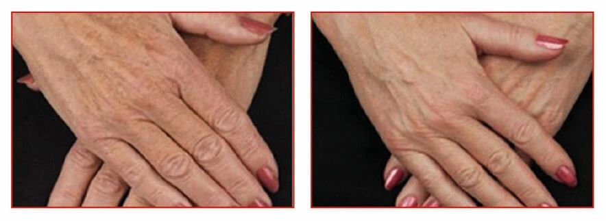 PRX-T33 treatment results on hands showing skin improvement