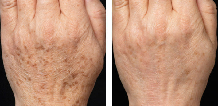 Age Spots Bluefern Spa Age Spots Bluefern Spa